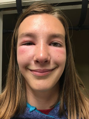 A close up of Rachel Runzheimer's face with multiple swollen bee stings on it, including a half way shut, swollen eye. 